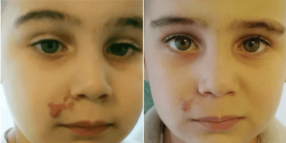 Birthmark Removal Treatment