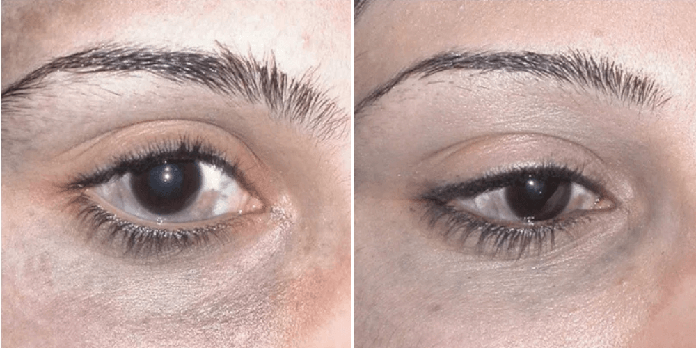 Birthmark Removal Treatment