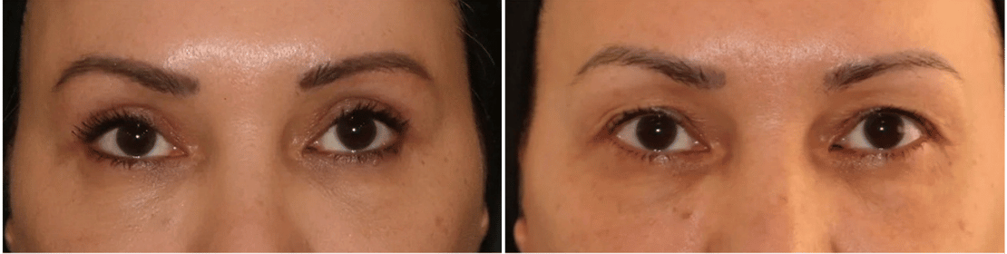 Blepharoplasty Treatment