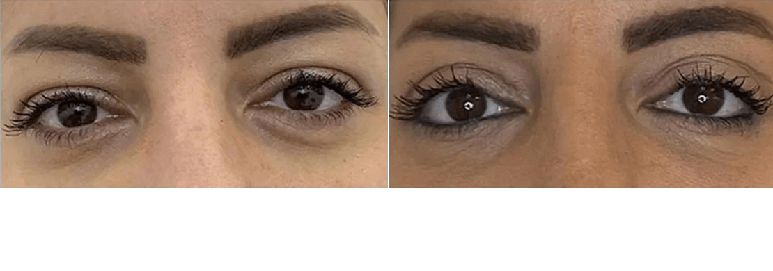Blepharoplasty Treatment