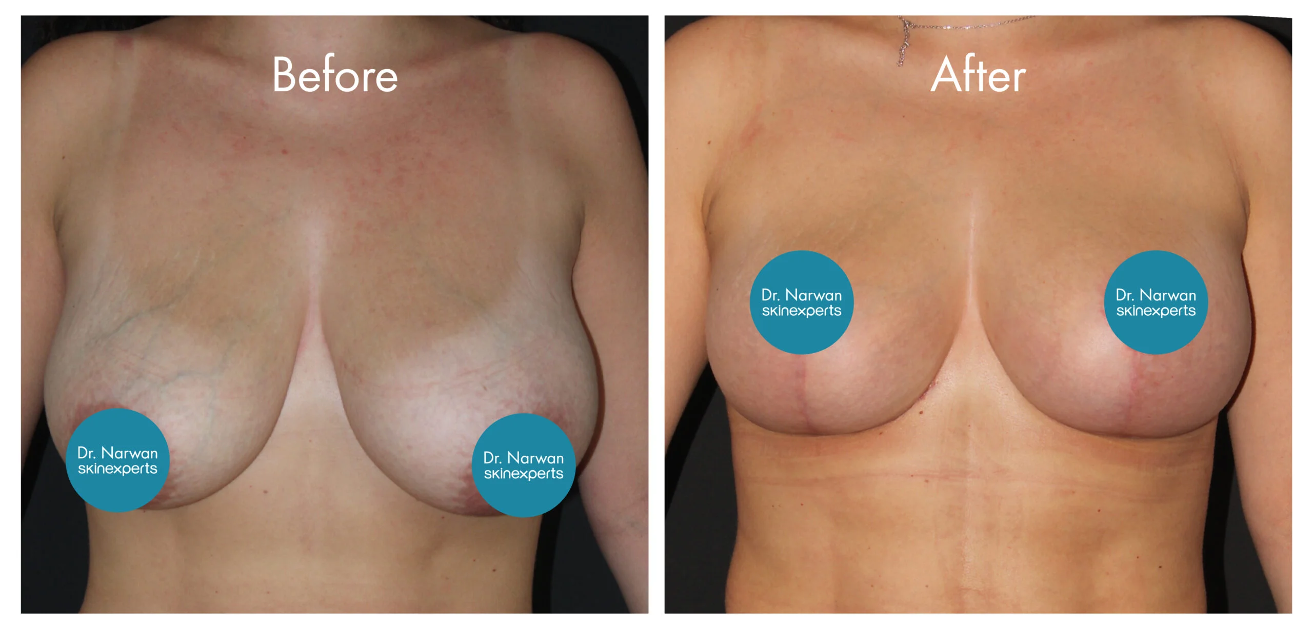 Breast Lift & Reduction