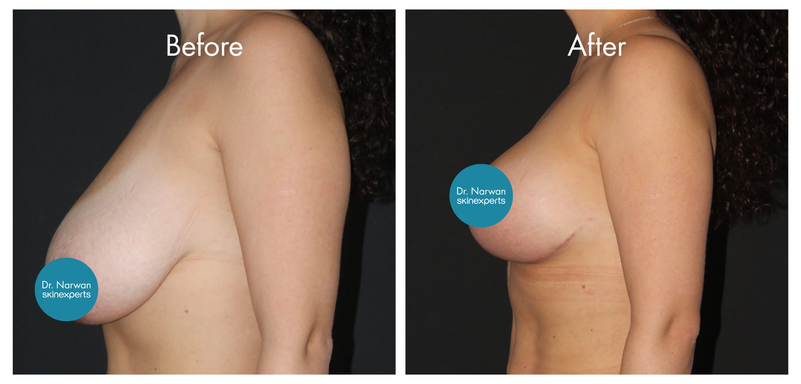 Breast Lift & Reduction
