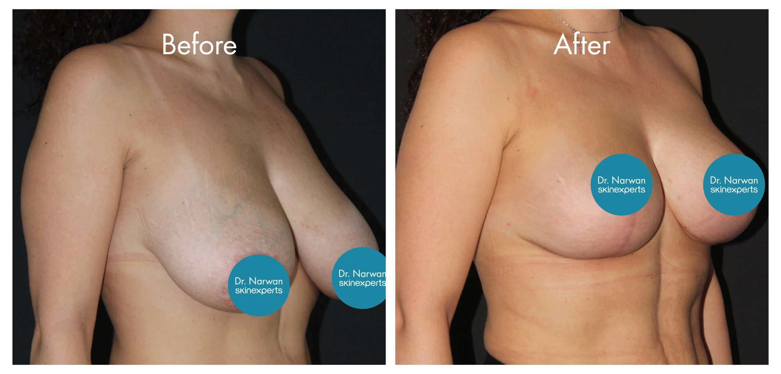 Breast Lift & Reduction