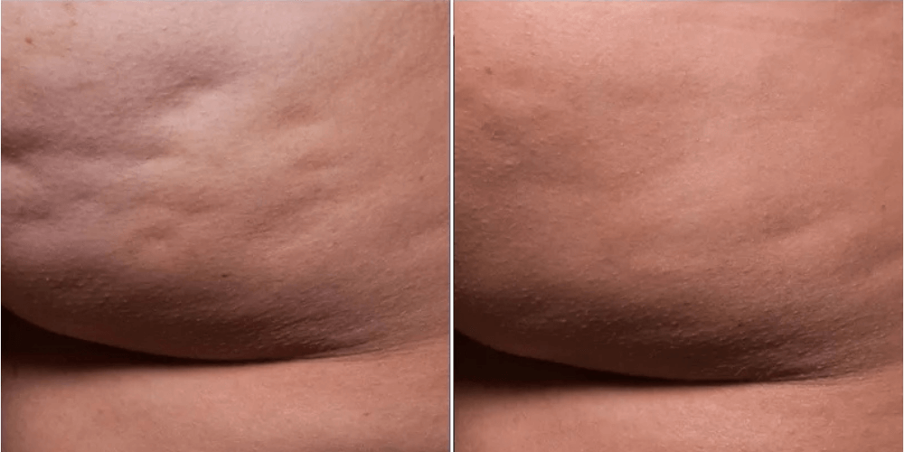 Cellulite Treatment
