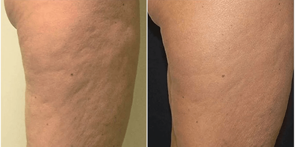 Cellulite Treatment