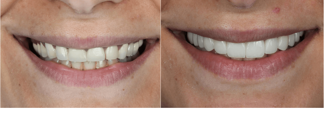 Crown and Dental Bridge