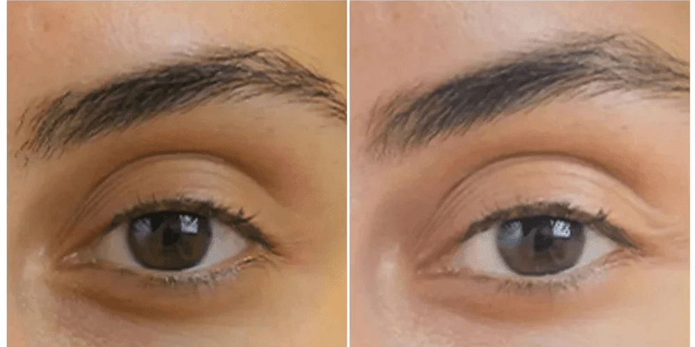 Eyelid Rejuvenation & Dark Circle Treatment