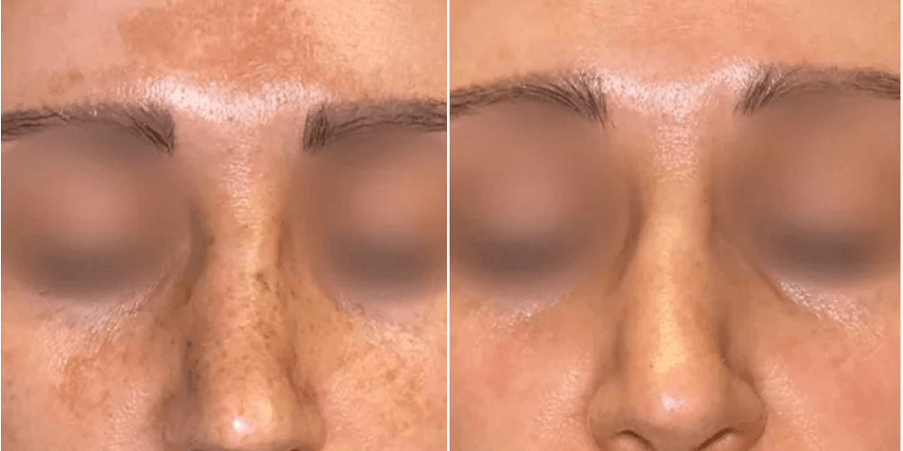 Scar, Dark Spot & Melasma Treatment