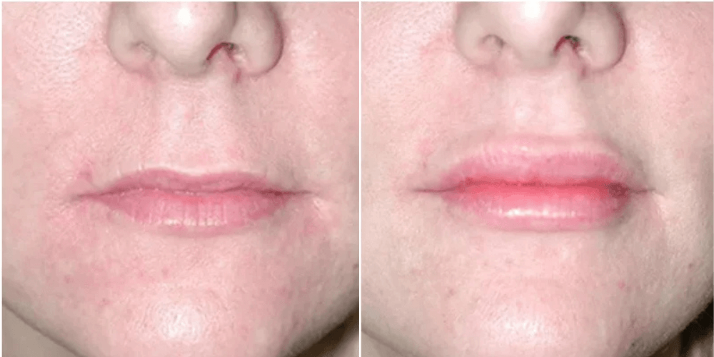 Dermal Filler Treatment