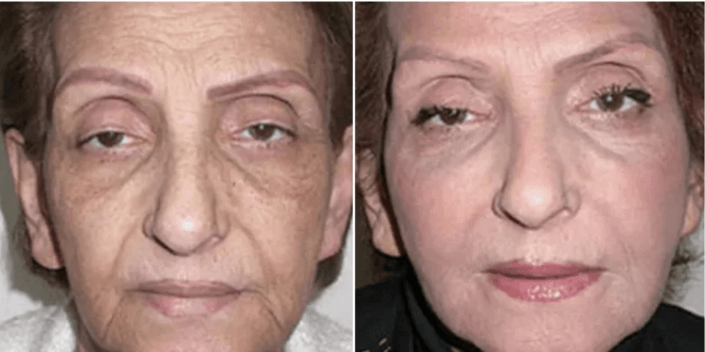Dermal Filler Treatment