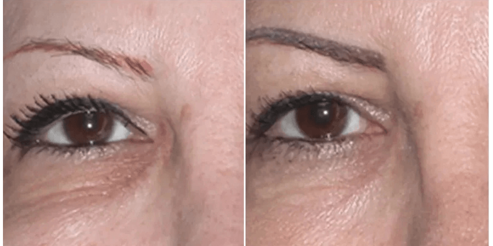 Eyelid Rejuvenation & Dark Circle Treatment