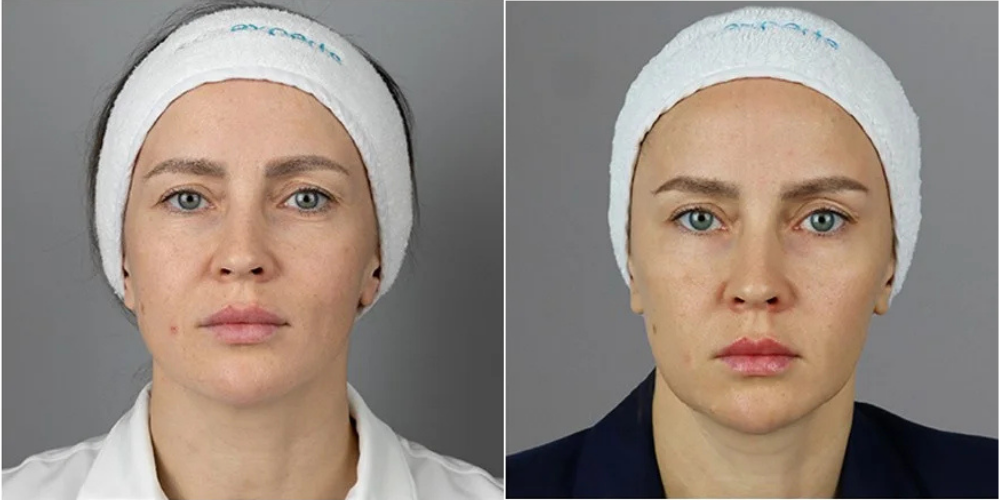 Facial Rejuvination