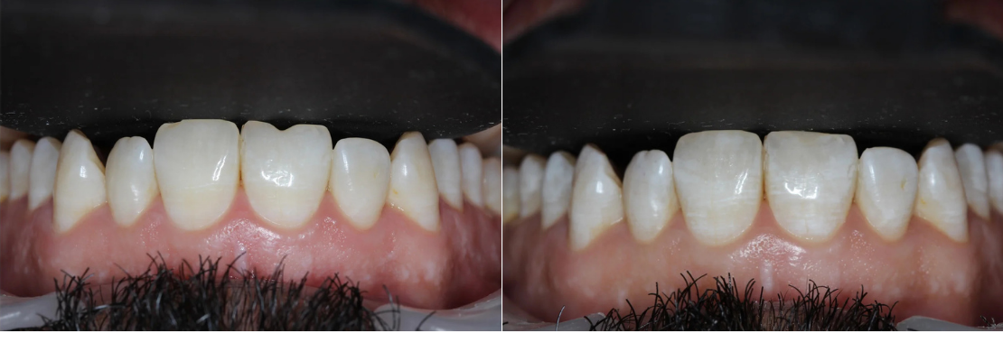 Full Mouth Reconstruction
