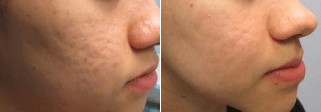 Genius RF Microneedling