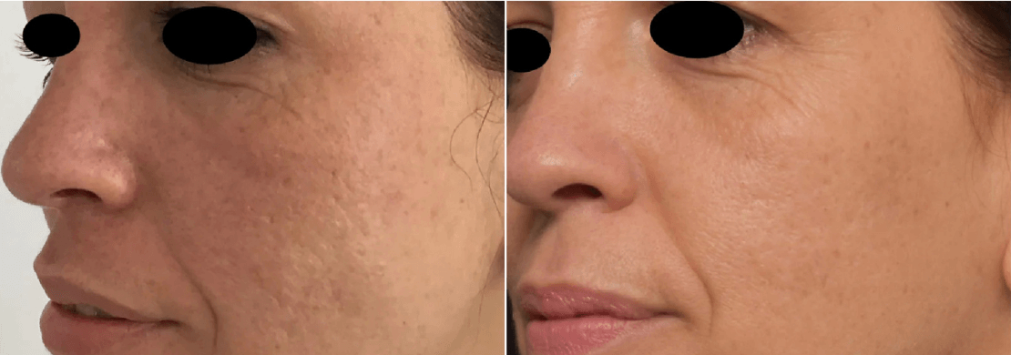 Genius RF Microneedling