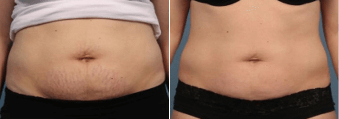 Genius RF Microneedling