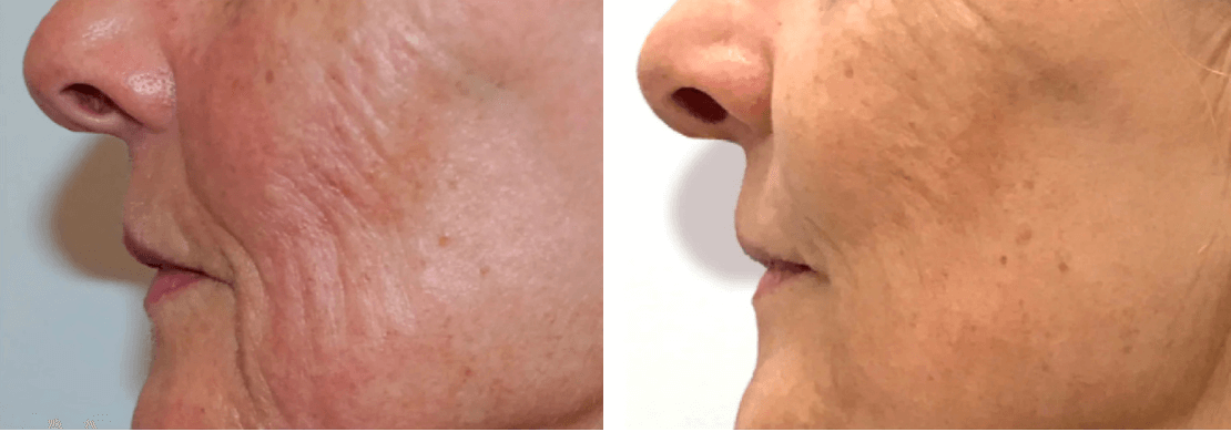 Genius RF Microneedling