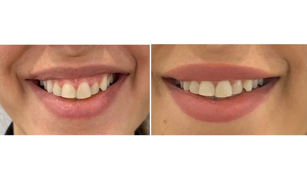 Gum and Periodontal Disease