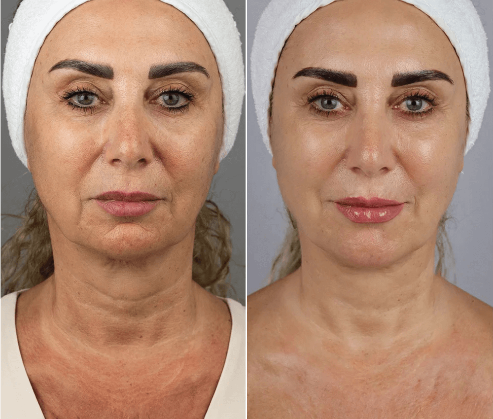 HIFU (High-Intensity Focused Ultrasound)