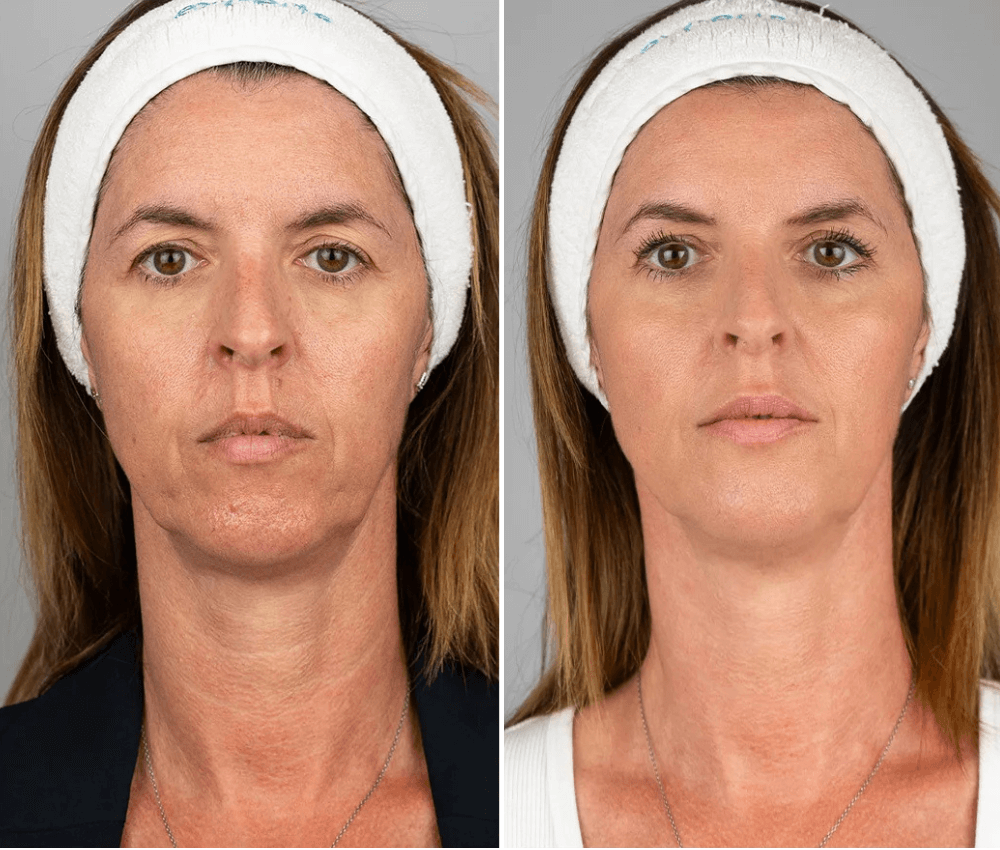 HIFU (High-Intensity Focused Ultrasound)