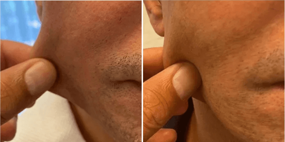 HIFU (High-Intensity Focused Ultrasound)