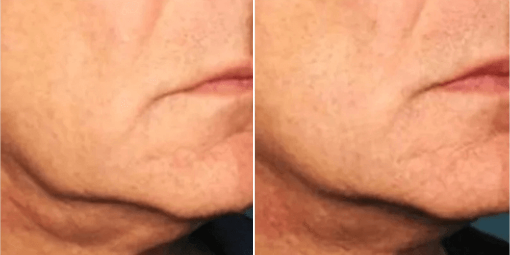 HIFU (High-Intensity Focused Ultrasound)