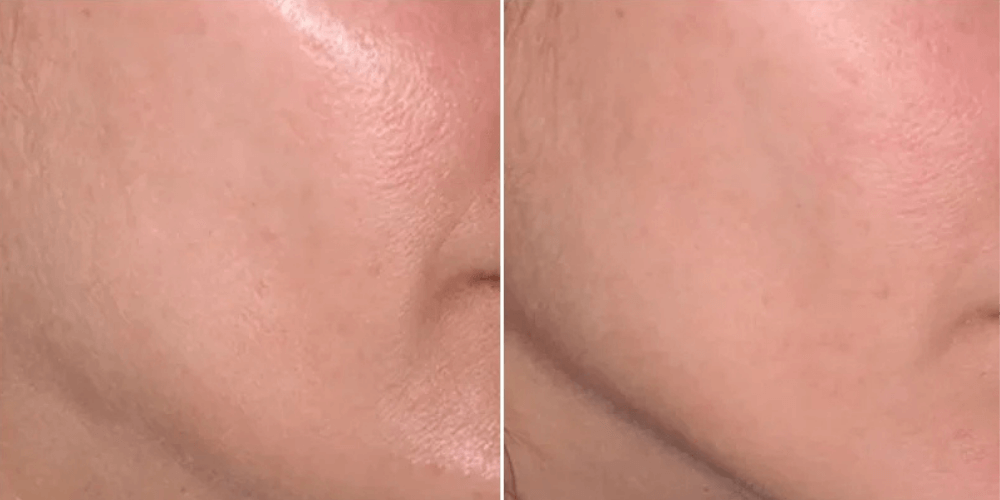 HIFU (High-Intensity Focused Ultrasound)