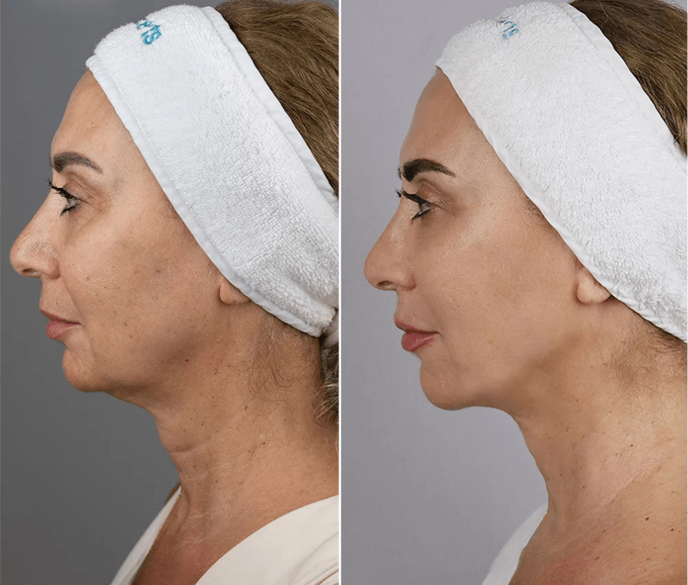 HIFU (High-Intensity Focused Ultrasound)