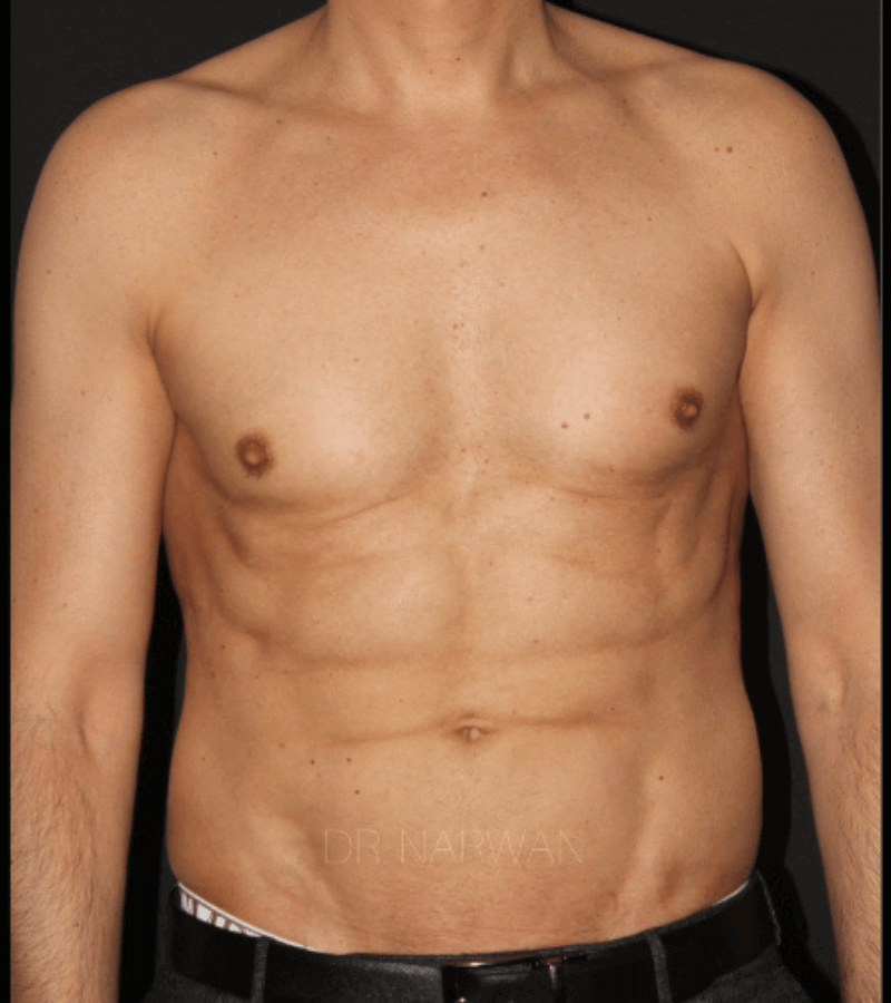 High Defination Body Contouring for Men