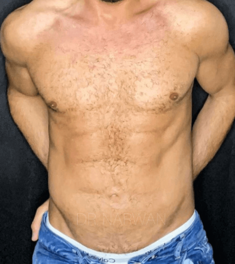 High Defination Body Contouring for Men