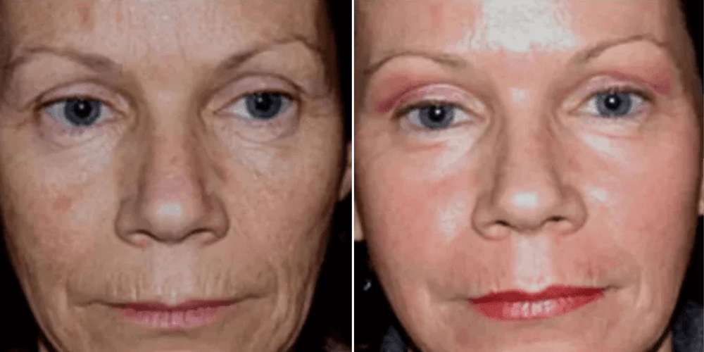 Laser Resurfacing Treatment