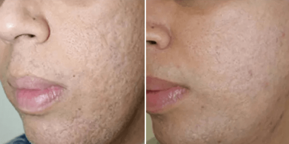 Laser Resurfacing Treatment