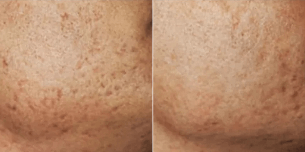 Laser Resurfacing Treatment