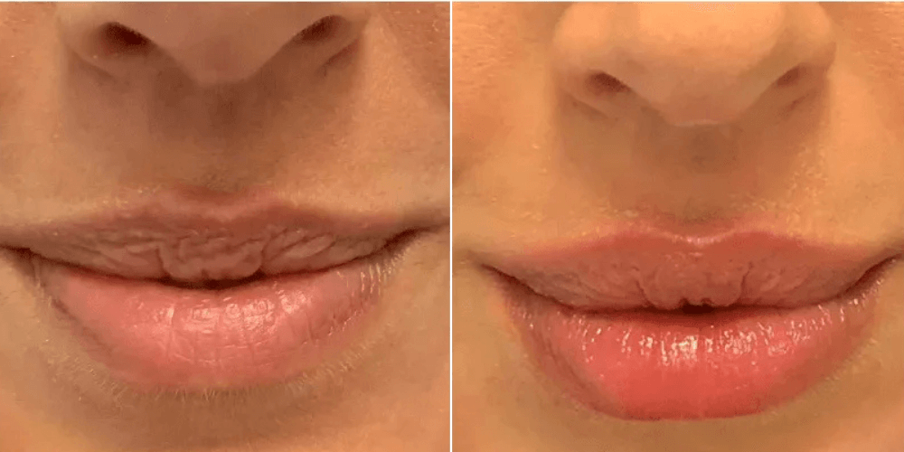 Lip Rejuvenation Augmentation