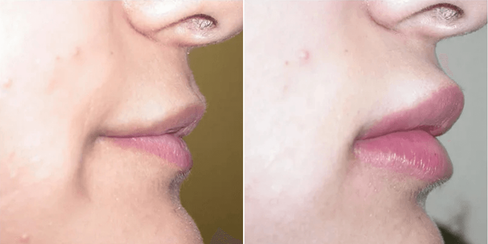 Lip Rejuvenation Augmentation