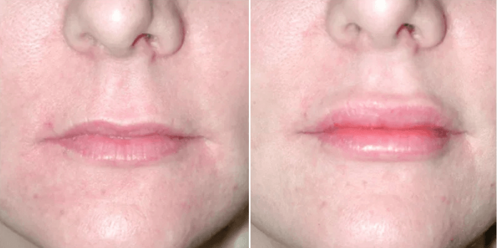 Lip Rejuvenation Augmentation