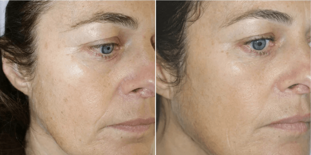 Mesotherapy Treatment