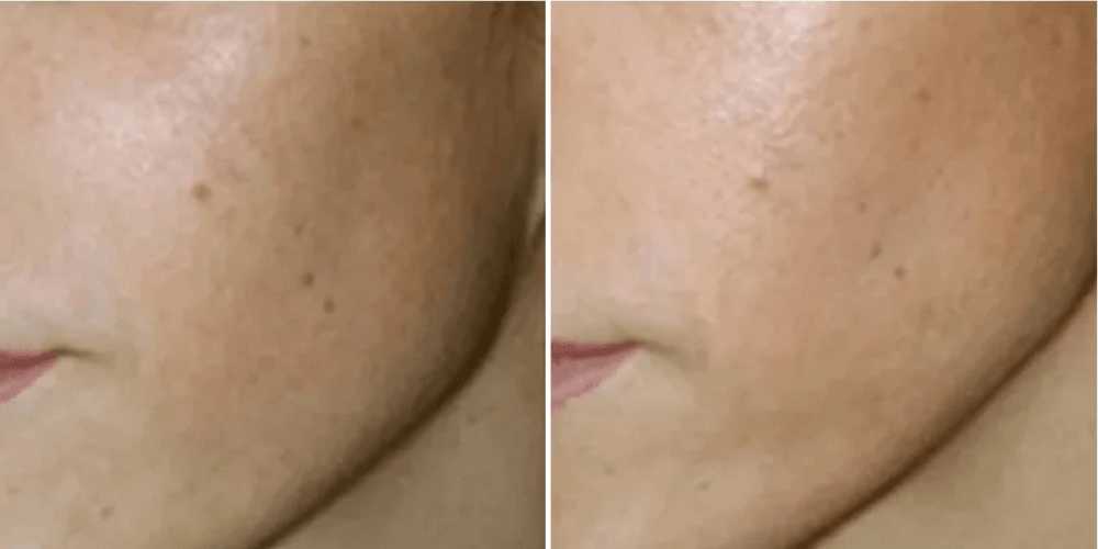 Mesotherapy Treatment