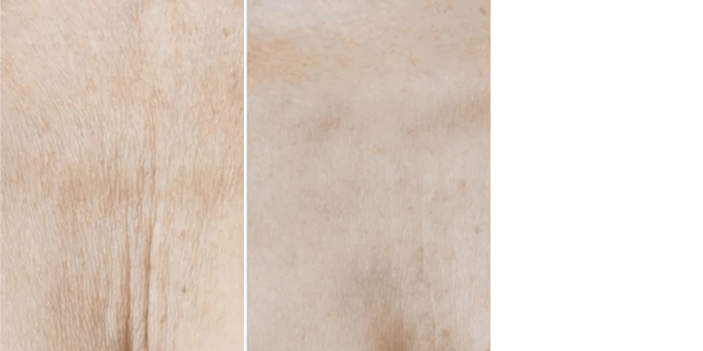 Mesotherapy Treatment