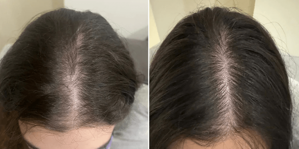 Platelet Rich Plasma (PRP)