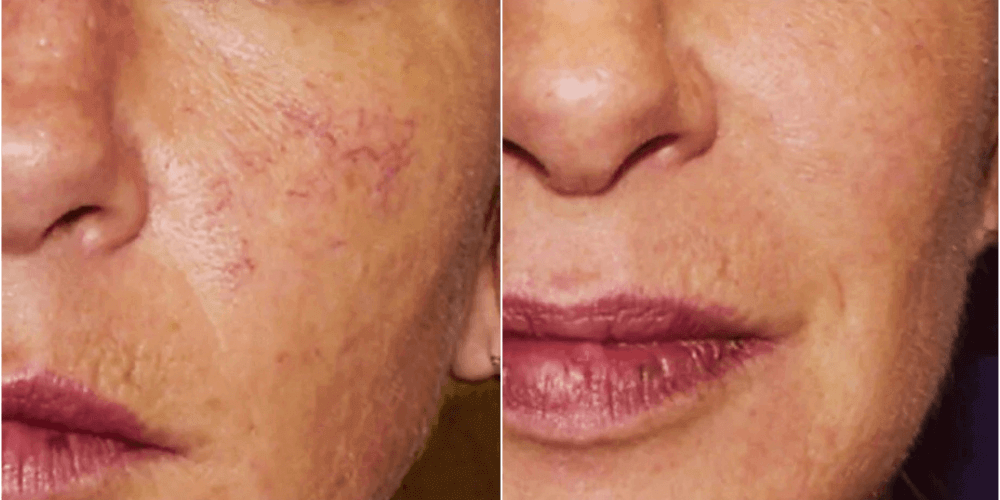 Rosacea Treatment