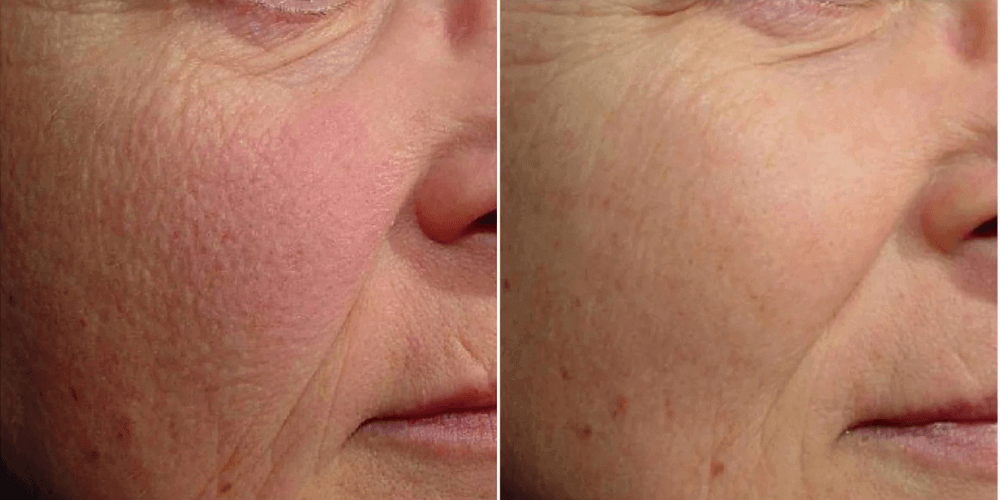 Rosacea Treatment