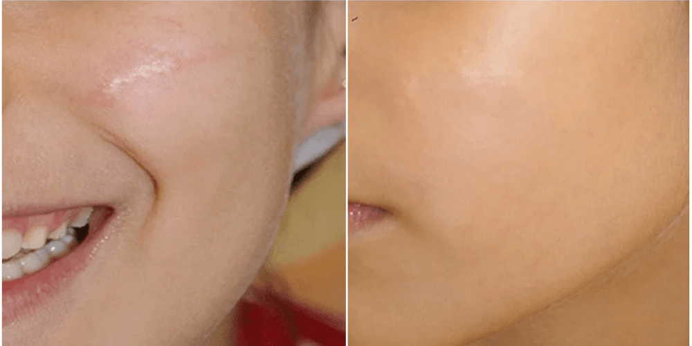 Scar, Dark Spot & Melasma Treatment