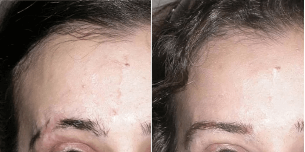 Scar, Dark Spot & Melasma Treatment