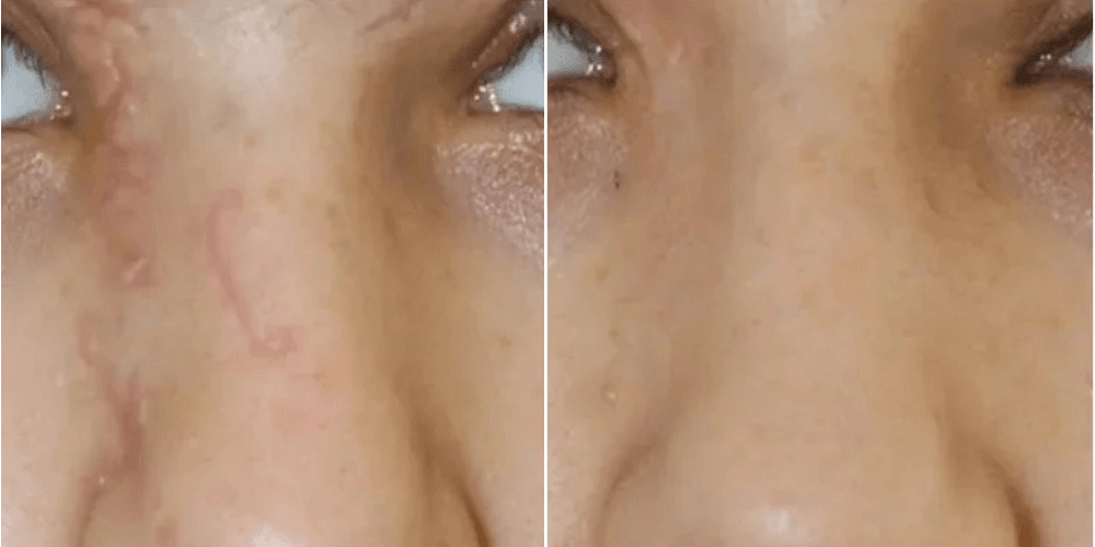 Scar, Dark Spot & Melasma Treatment
