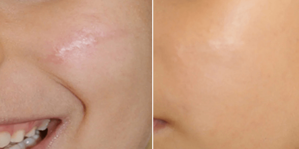 Scar & Stratch Marks