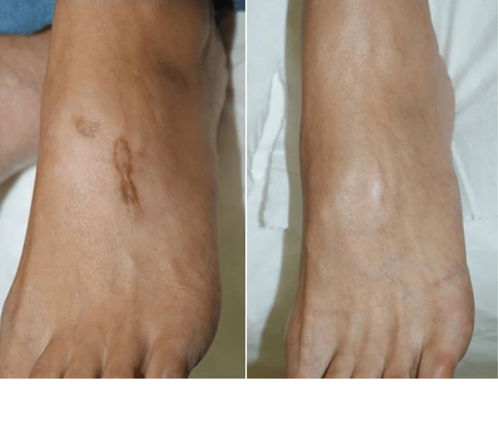 Scar & Stratch Marks