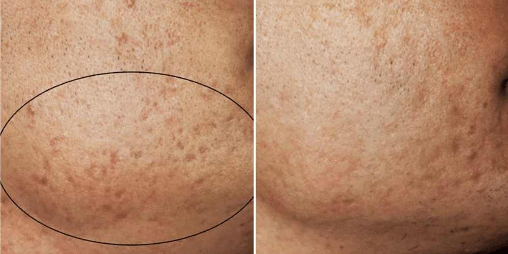 Scar & Stratch Marks