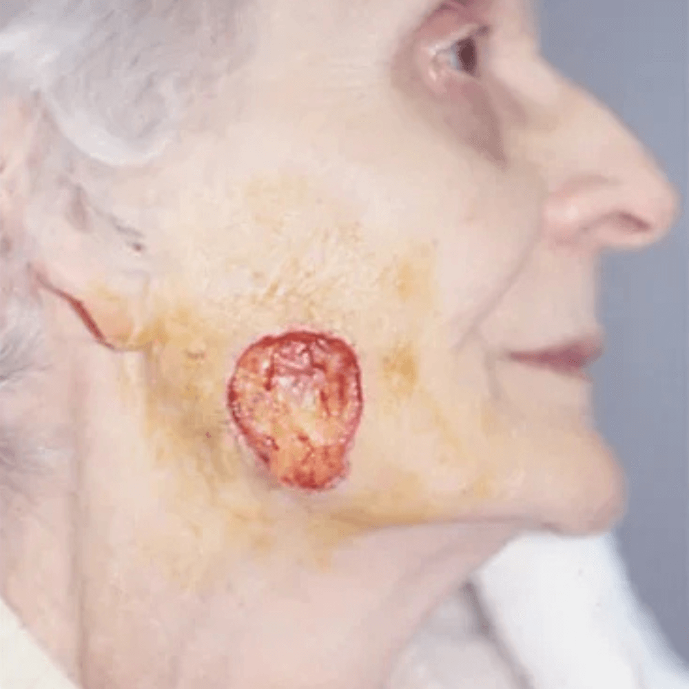 Skin Cancer Treatment