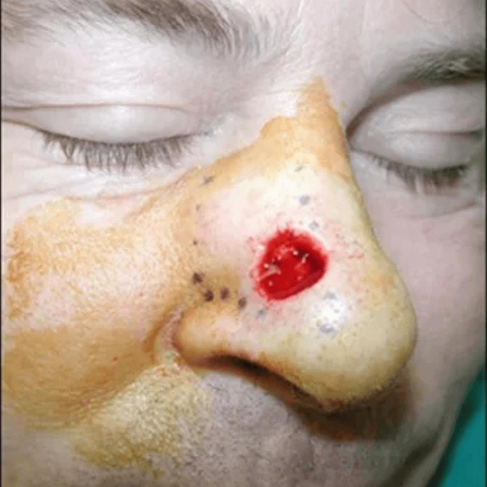 Skin Cancer Treatment